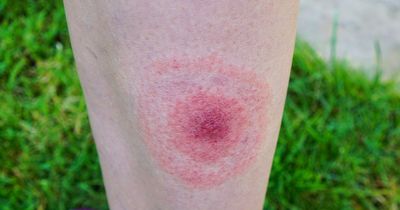 The full list of Lyme Disease symptoms and signs to look out for amid UK warning