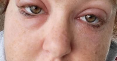 Mum trapped in damp home has severe allergic reaction to mould as her eyes SWELL
