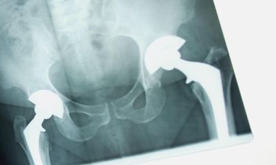 UK study highlights heart disease risk from older types of hip replacement