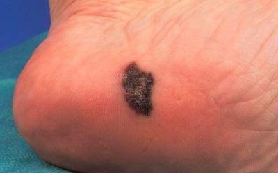 Where the sun doesn’t shine, you can get melanoma anyway