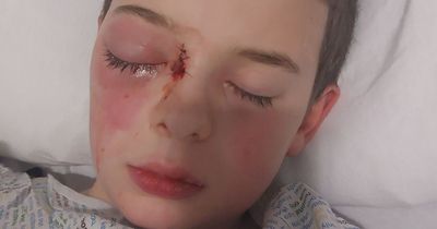 Scots schoolboy 'hours away from losing eye' after Strep A caused major infection