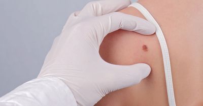 Skin cancer symptoms to look out for including vital checklist for mole changes