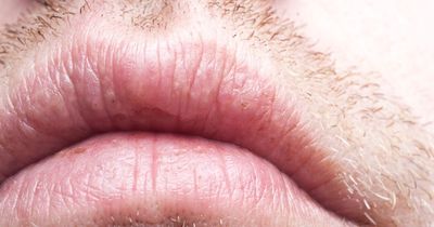 Why a dry mouth could be a cause for concern - the five worrying illnesses it could signal