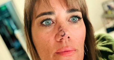 Woman diagnosed with skin cancer after covering spot on nose with concealer for months