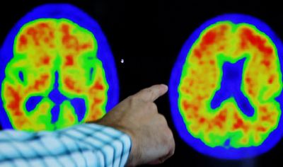 ‘Remarkable’ drug reduces Alzheimer’s decline, study shows