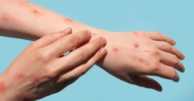 Fears killer virus is spreading after man suddenly falls ill with severe rash