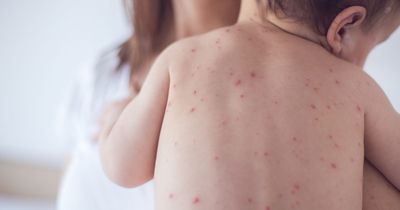 Four measles red flags everyone should know amid surge in cases and urgent warning