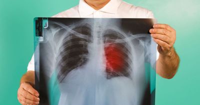Lung cancer warning as people urged to do 'finger test' to see early signs of disease
