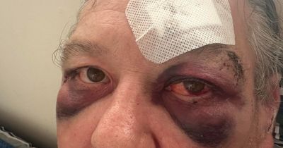 Man who was battered black and blue by teenage gang in West Lothian park says he 'didn't know if he would survive'