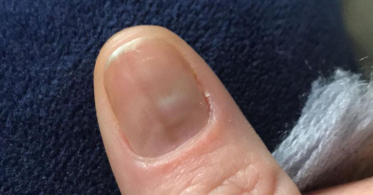 scots-mum-s-bruise-under-fingernail-turned-out-to-be