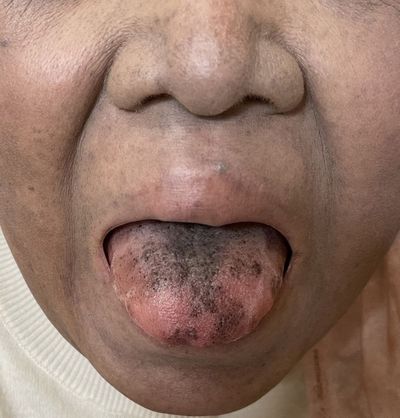 Cancer patient’s tongue turned black and hairy ‘after rare antibiotics reaction’