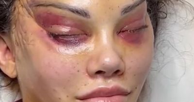 Influencer deforms face after invasive surgery to give herself 'cat's eyes'