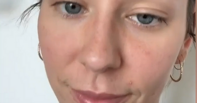 Ex-vegan says returning to meat stopped hair falling out and saved her life