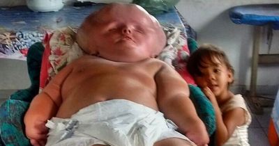 Baby born with expanding head that won't stop growing due to rare condition