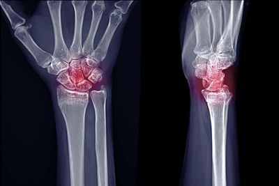 Up to one in three with rheumatoid arthritis ‘at risk of long-term opioid use’