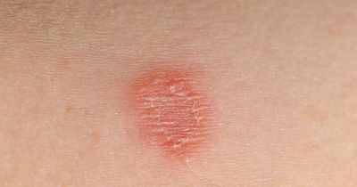 Tinea symptoms as two cases of drug resistant fungal infection confirmed
