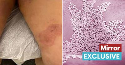 Warning 'world not prepared' as women infected with highly contagious fungal disease