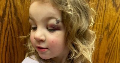 Dad's anger after toddler left 'bloodied and bruised' in nursery incident