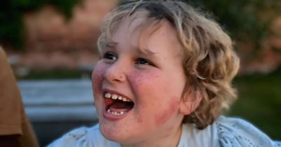 Eight-year-old from Nottinghamshire has rare condition which affects one in 10,000 people