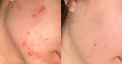 Shoppers claim £23 Facetheory's Vitamin C Serum has 'improved acne and scars'