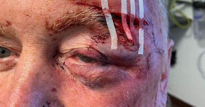 Pensioner beaten by Commando so badly doctors thought he'd been in crash