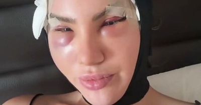 Love Island star slams fans who say she's 'ruined face' with drastic fox eye facelift