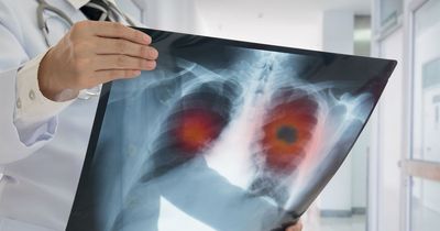'Clever new tool predicts your risk of developing lung cancer'