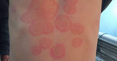 Symptoms of unusual fungal disease that causes scaly rashes on body - and could become more common