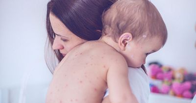 Warning issued as Victorian disease measles reported in 17 European countries