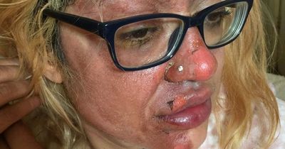 Mum left badly burned after trying TikTok egg 'hack'