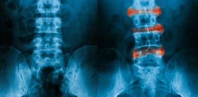 Ankylosing spondylitis: machine learning could pave the way for early diagnosis of inflammatory arthritis