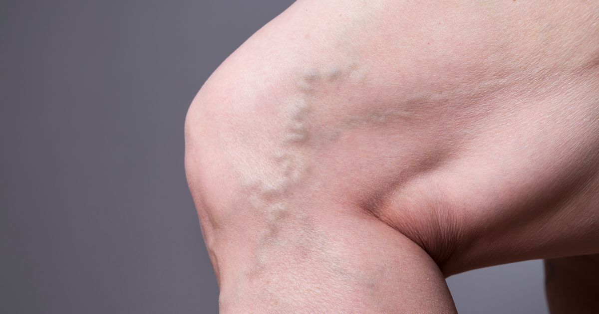 Blood clot signs you should never ignore before…