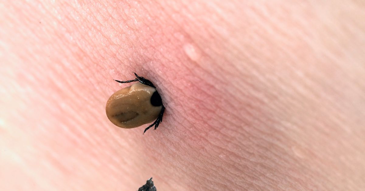 experts-share-safest-way-to-remove-ticks-from-skin