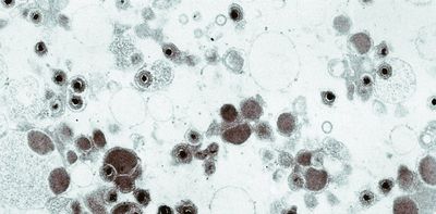 Cytomegalovirus lies dormant in most US adults and is the leading infectious cause of birth defects, but few have heard of it