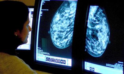Breast cancer drug cuts risk of most common form returning by 25%