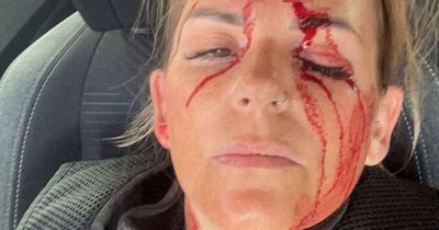 Police officer's horrific injury suffered while arresting suspected drug dealer