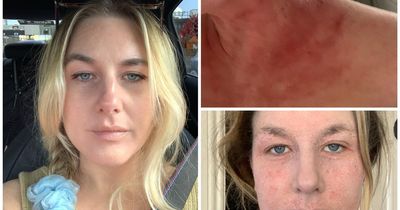 Skin condition 'not recognised' by doctors devastated life of healthy Chester-le-Street woman in her 30s