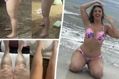 ‘I thought I was curvy but 6.5 litres of fluid in my legs was actually due to rare condition’