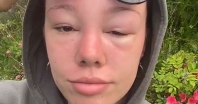 Holidaymaker's face left swollen from sun poisoning