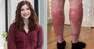 'I have a rare disease where my skin tears away from my body and I can't sleep or sit down'