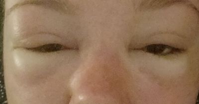Woman, 22, could barely open eyes after 'stupid' sun mistake