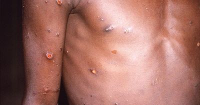 Call for new vaccine roll-out after spike in Mpox cases in UK