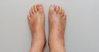 Six tips to get rid of swollen feet and ankles with 'excess fluid' in hot weather