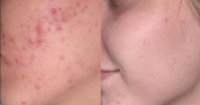 'I've stopped using moisturiser for Summer since finding a five-star rated face mask that gives flawless skin in 10 minutes'