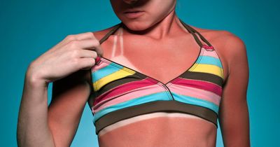 Three budget hacks to relieve sunburn fast – and there's one you should never do