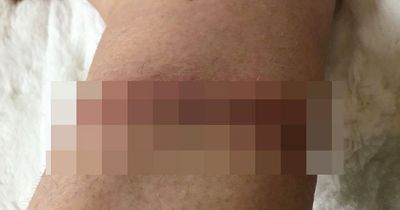 Woman suffers gruesome 'garrotte' injury as she issues warning over dangerous dog leads