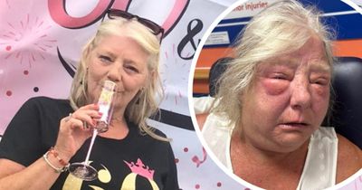 Woman suffers punctured lung, broken ribs, and facial injuries after being attacked at funeral