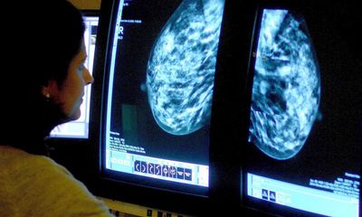 Most early-stage breast cancer patients will be long-term survivors – study