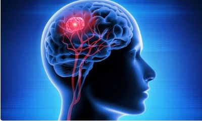 Study finds how brain waves can predict cognitive impairment in Parkinson's disease