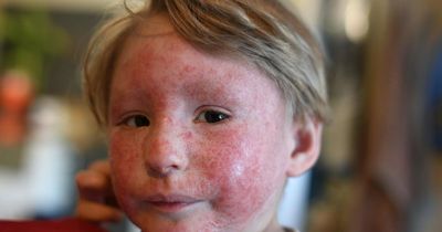 Mum needs £4,000 to fly son abroad for life-changing eczema therapy
